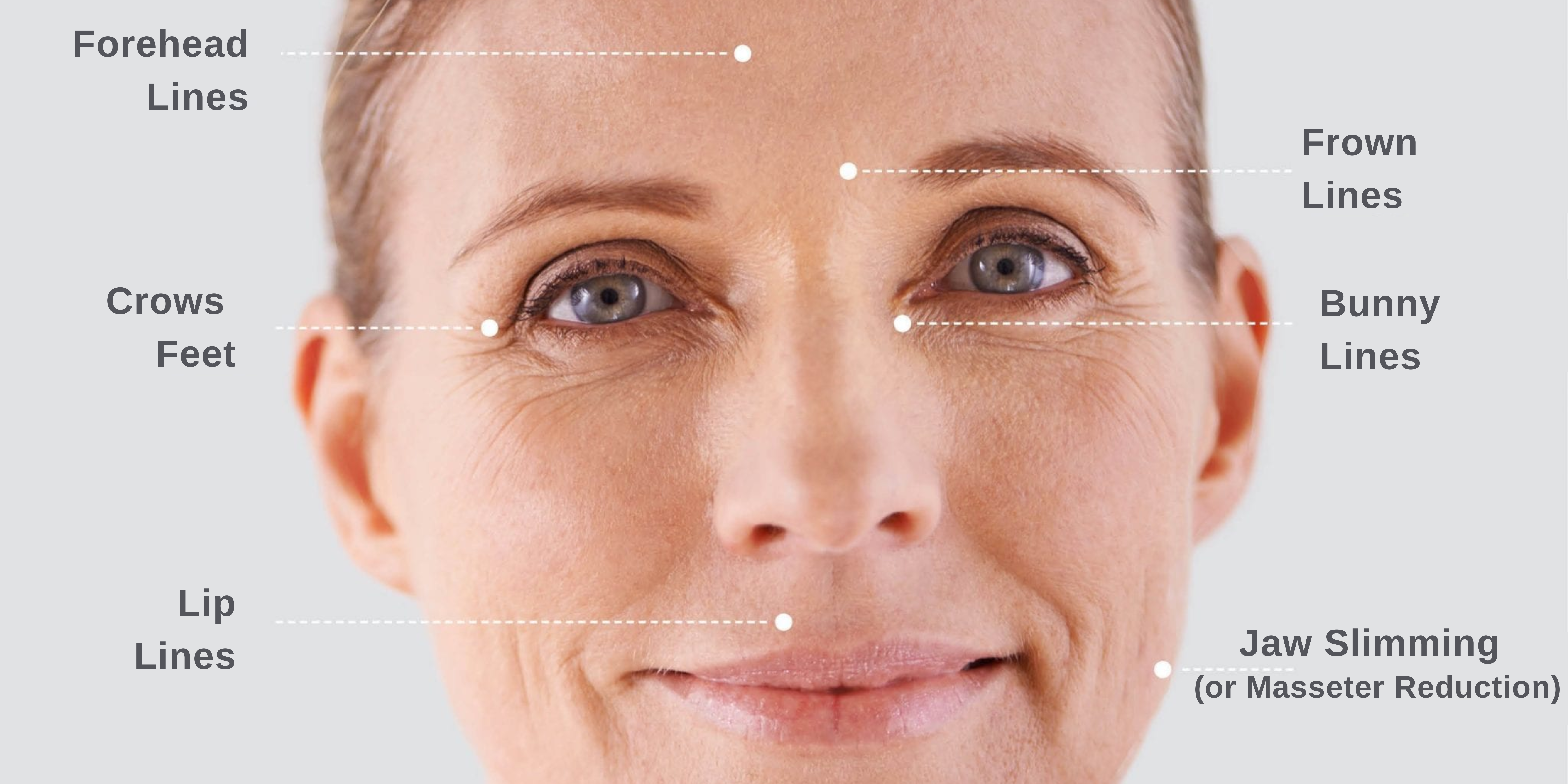 Botox treatment areas