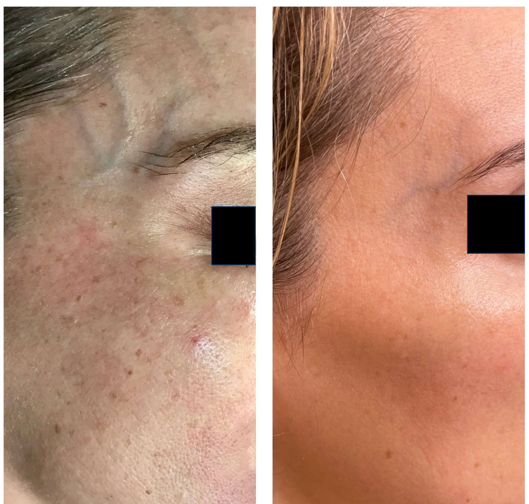 Before and After IPL Treatment at Illume Aesthetics