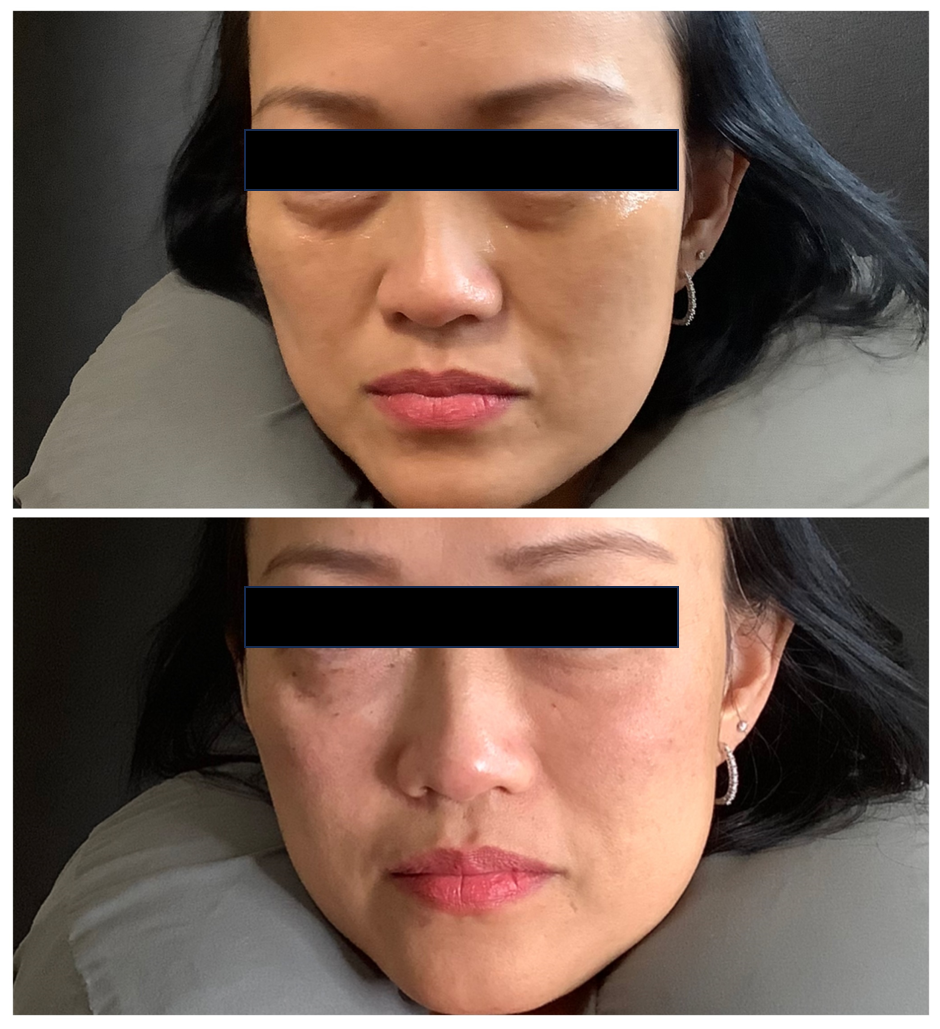 Before and After Under Eye Filler at Illume Aesthetics