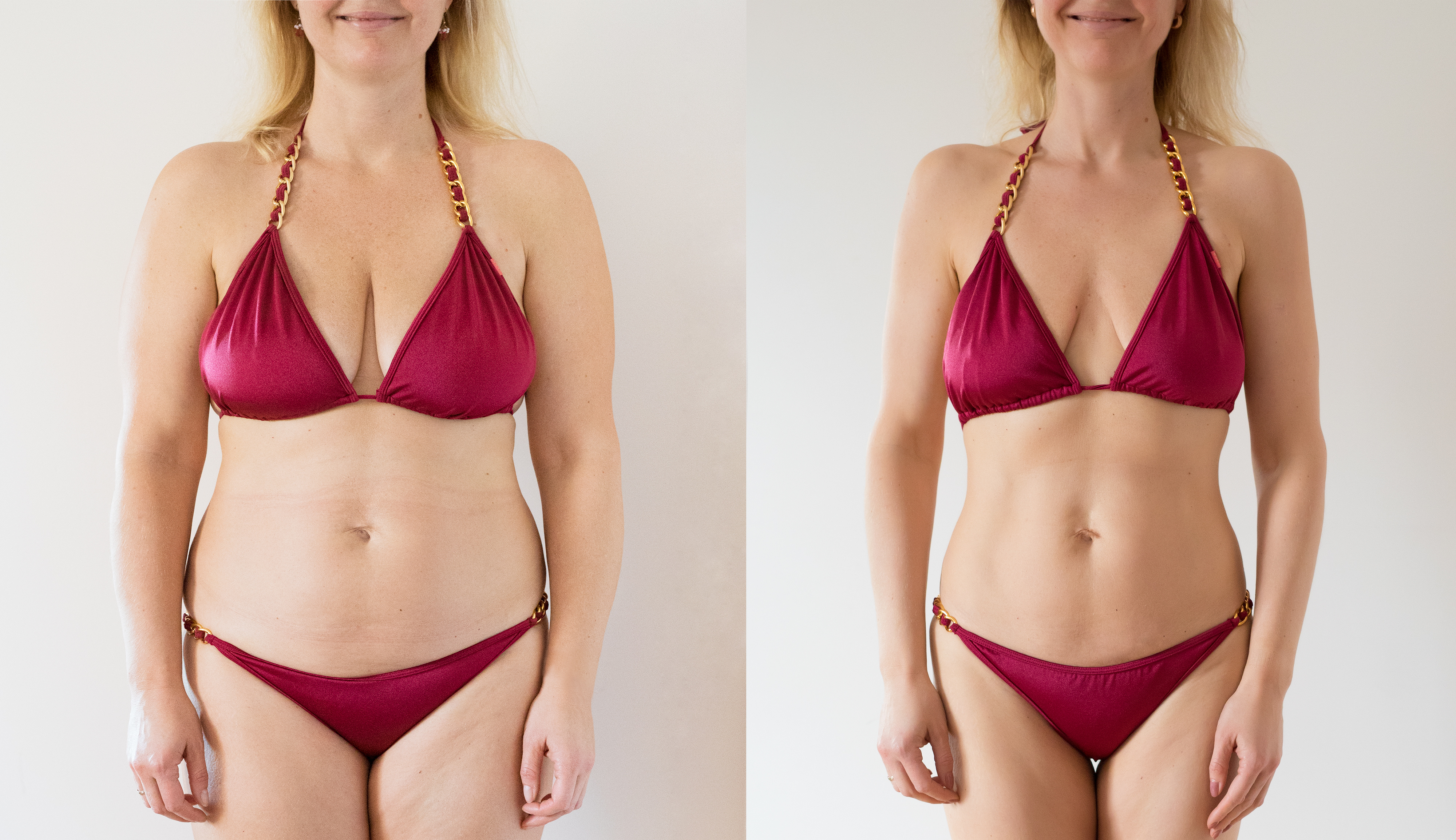lose inches with Sculptra