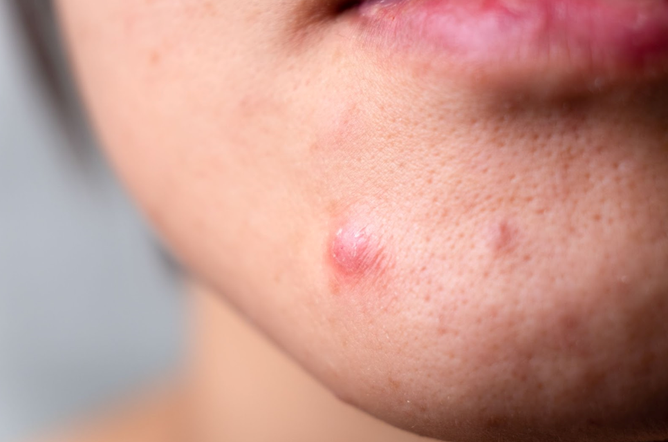 Ashland, Oregon's best acne treatment