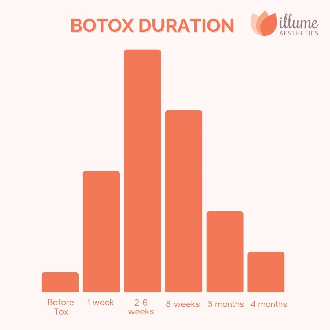 Botox Duration chart in Illume Aesthetics
