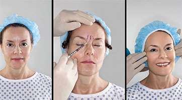 Botox: The Unsung Hero of the Pandemic