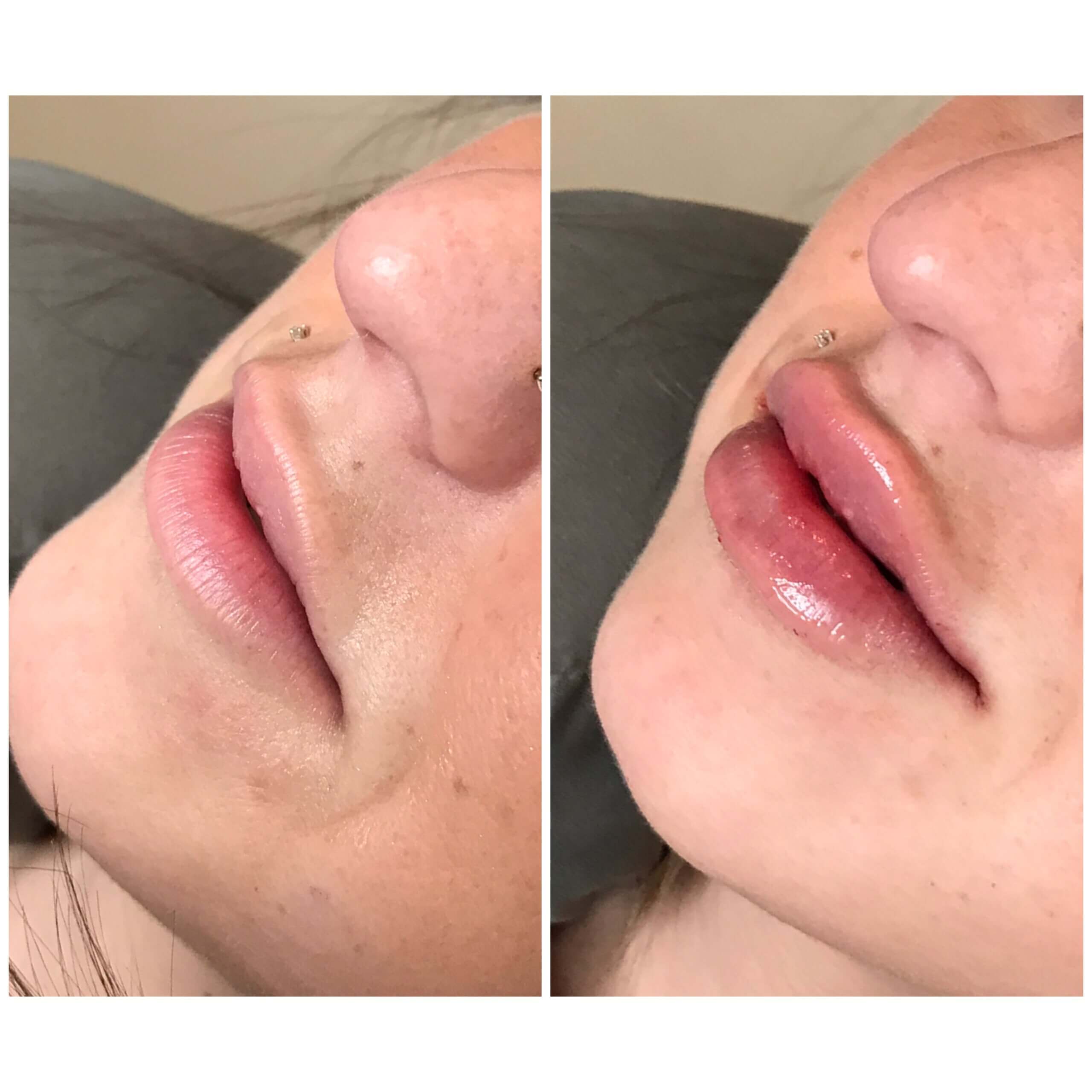 Lip filler before and after