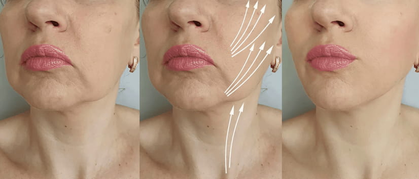 Non-Surgical Facelift Non-Surgical Facelift