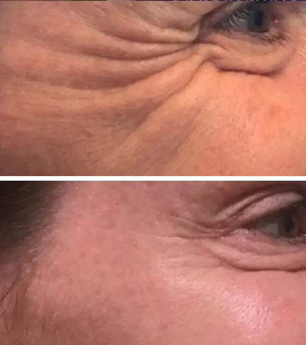 Botox before and after Illume Aesthetics Ashland OR Botox before and after Illume Aesthetics Ashland OR