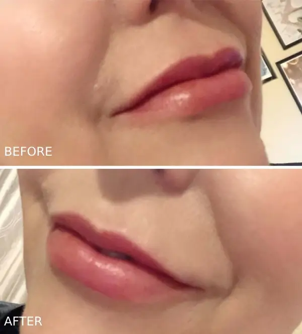 Before and After photos showing a plumper, reduced lip wrinkles, and more structured lips from lip fillers in Ashland Oregon.