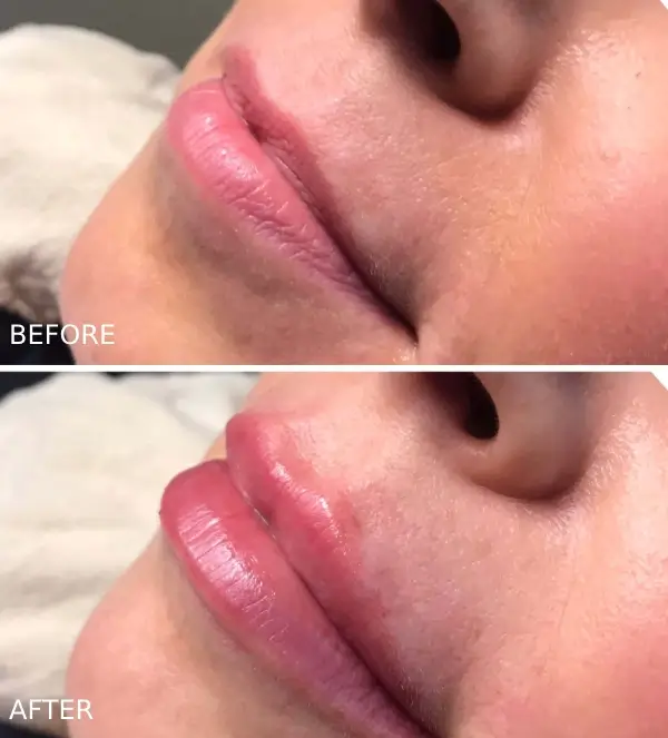 Lip Filler before and after photos showing plumper lips and reduced lip wrinkles results in Ashland, OR.