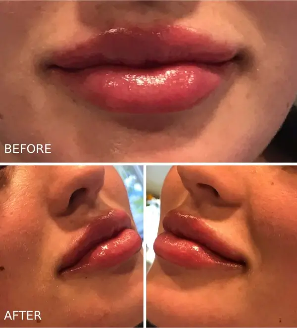 After photos showing a plumper lips, reduced lip wrinkles, and more structured lips from lip fillers in Ashland, Oregon.