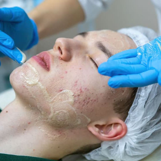 Illume Aesthetics Ashland OR acne treatment