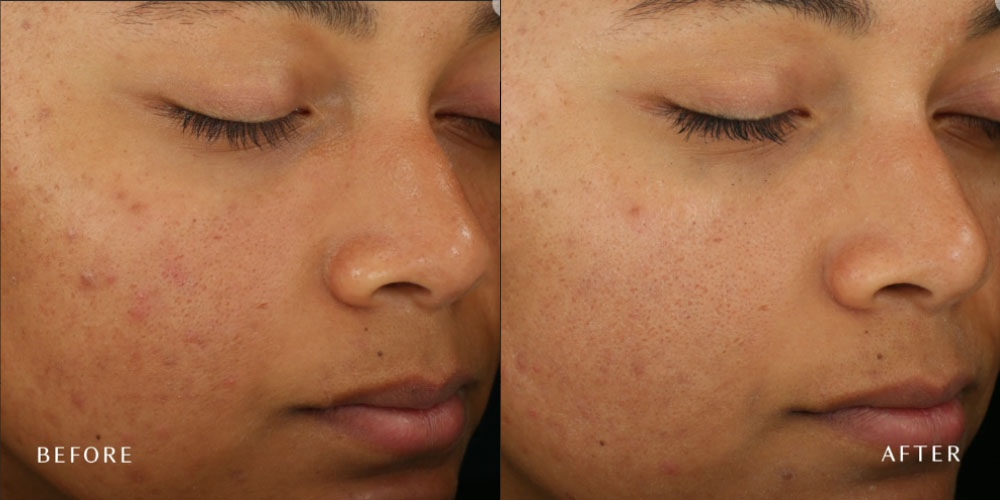 DiamondGlow before and after Illume Aesthetics Ashland OR DiamondGlow before and after Illume Aesthetics Ashland OR