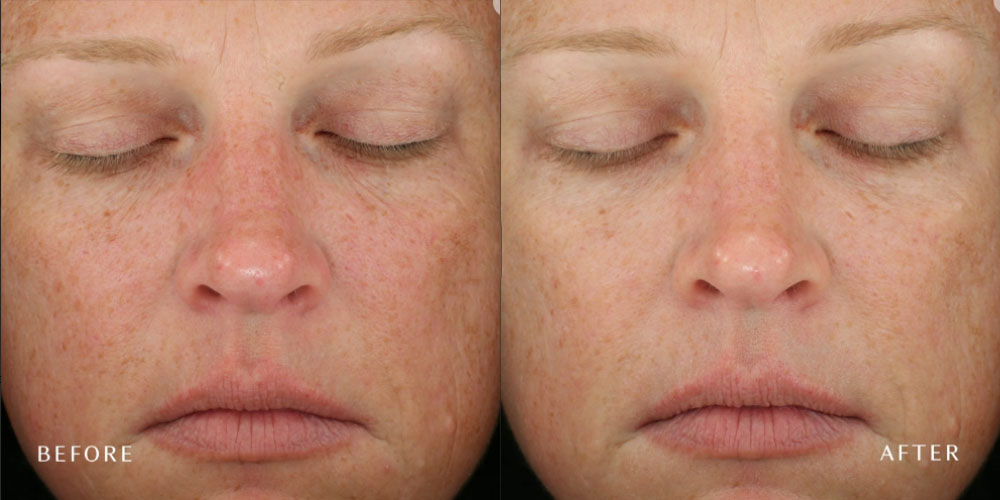 DiamondGlow before and after Illume Aesthetics Ashland OR DiamondGlow before and after Illume Aesthetics Ashland OR