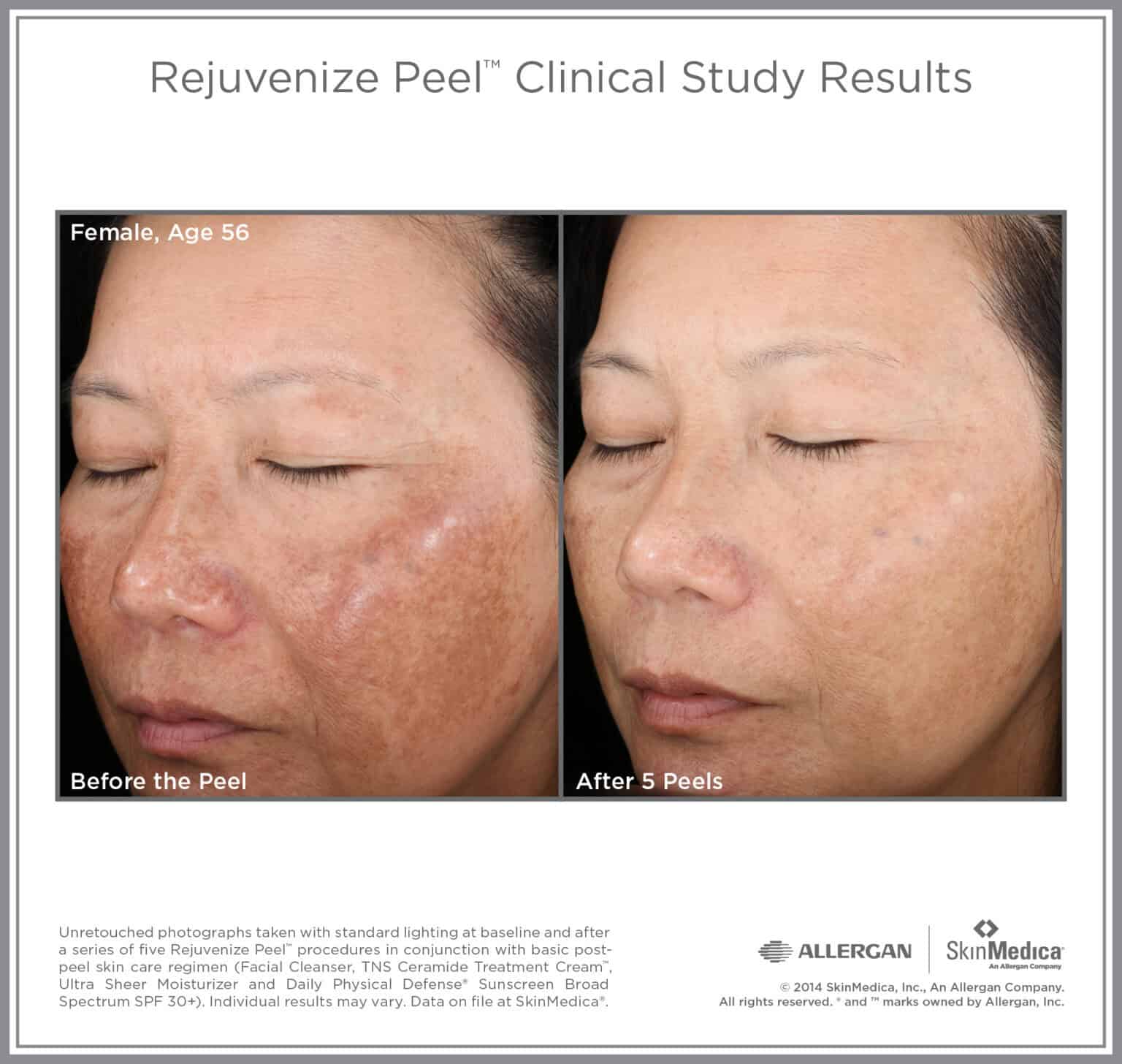 Rejuvenize Peel before and after — female, age 56, significant improvement in wrinkles and sun damage