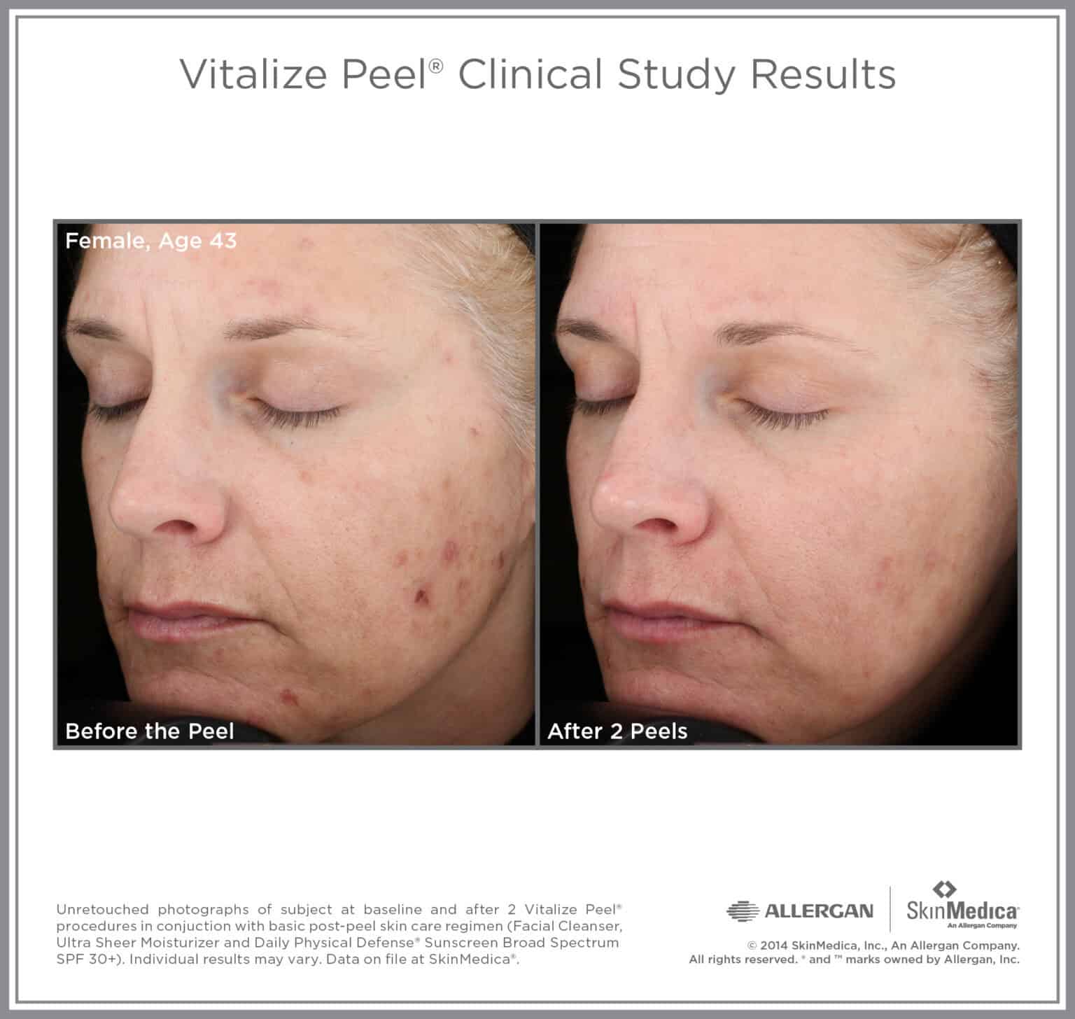 Vitalize Peel before and after — skin tone and texture improvement, female age 43