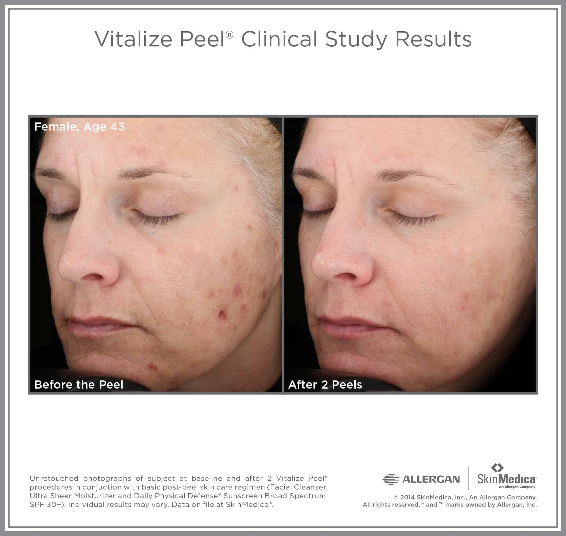 Vitalize Peel before and after — female, age 43, improvement in skin tone, texture, and fine lines