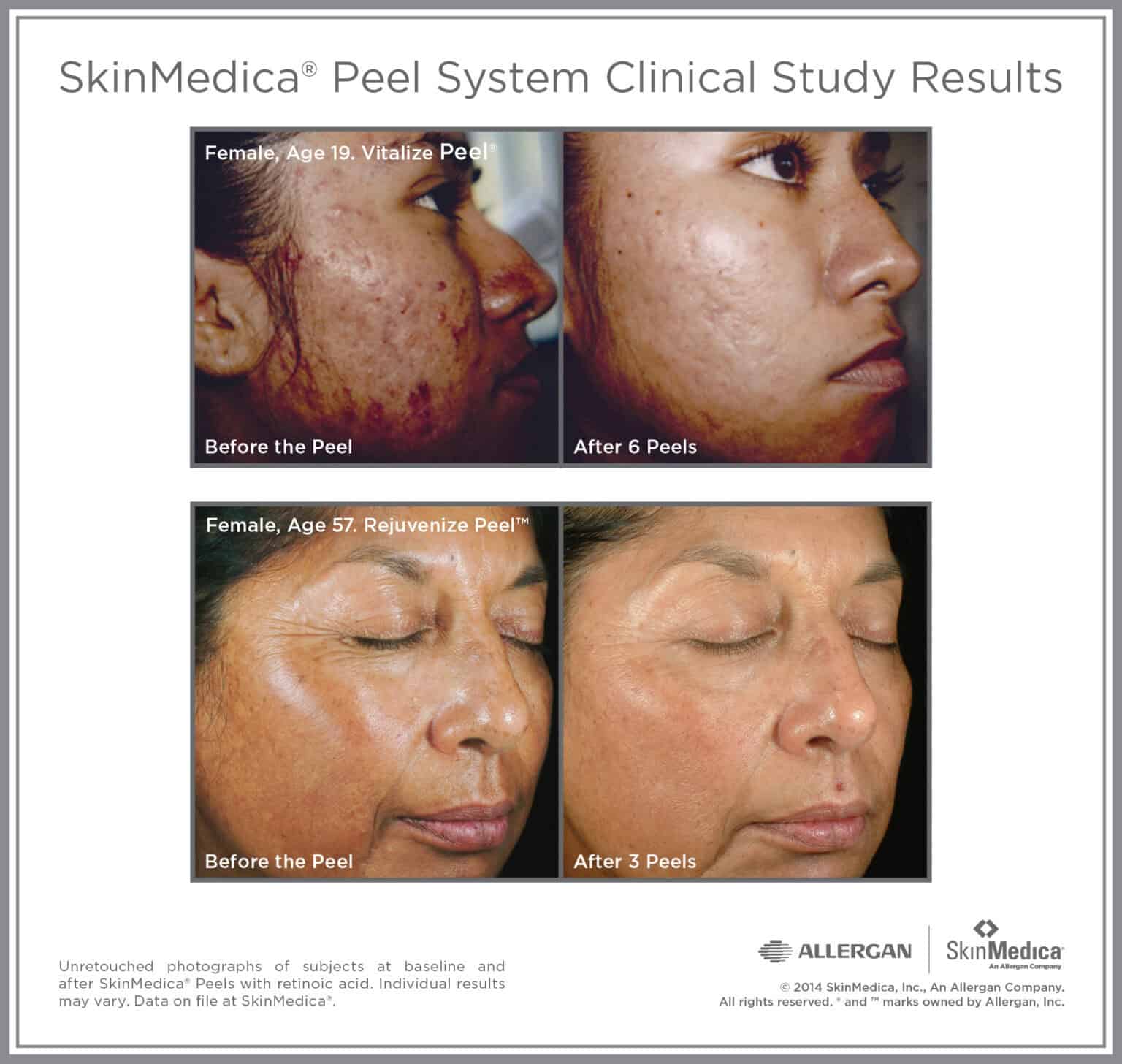 Vitalize and Rejuvenize Peel before and after — females age 19 and 57, improvement in acne and aging