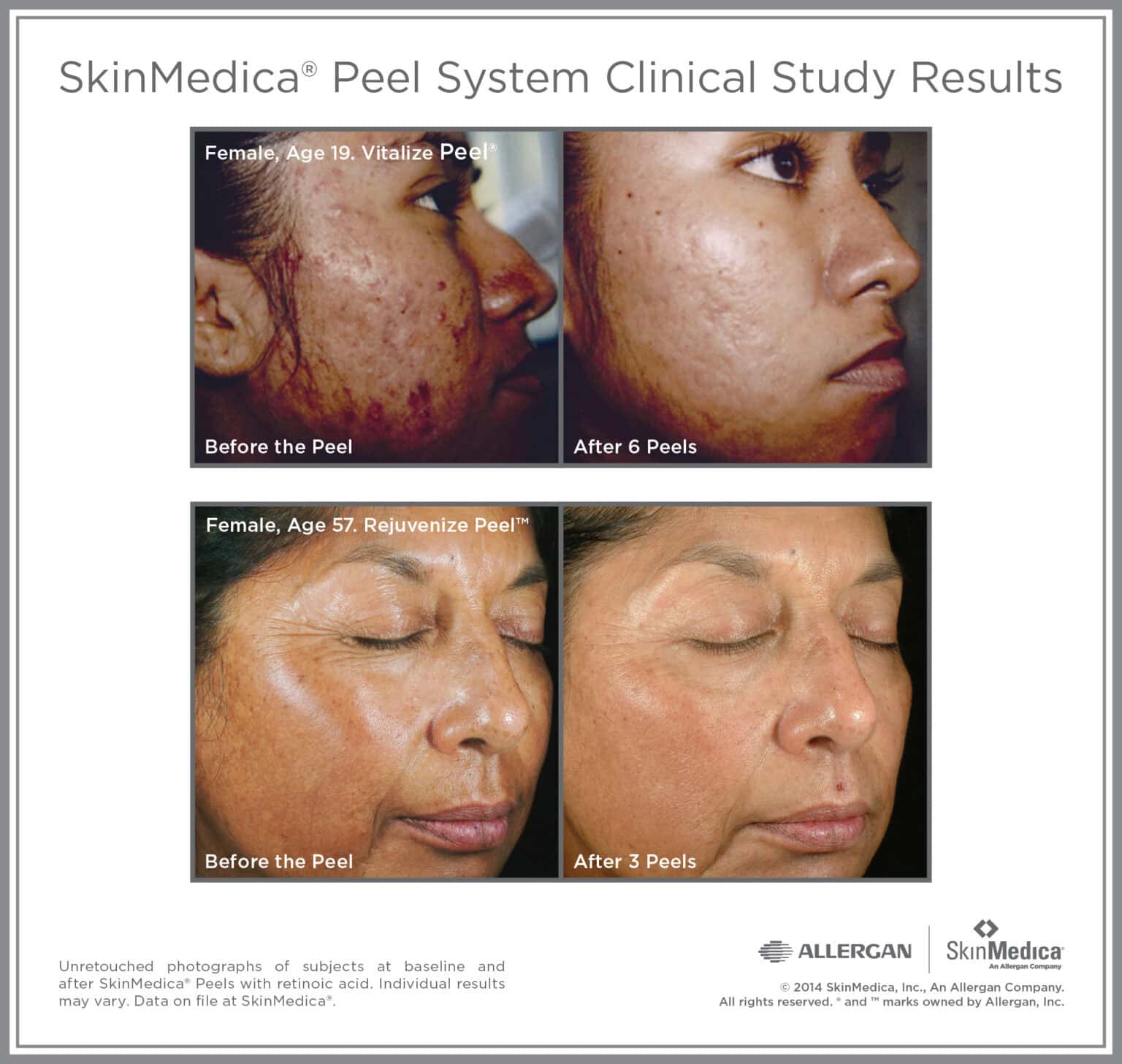 Vitalize and Rejuvenize Peel before and after — females age 19 and 57, improvement in acne and aging