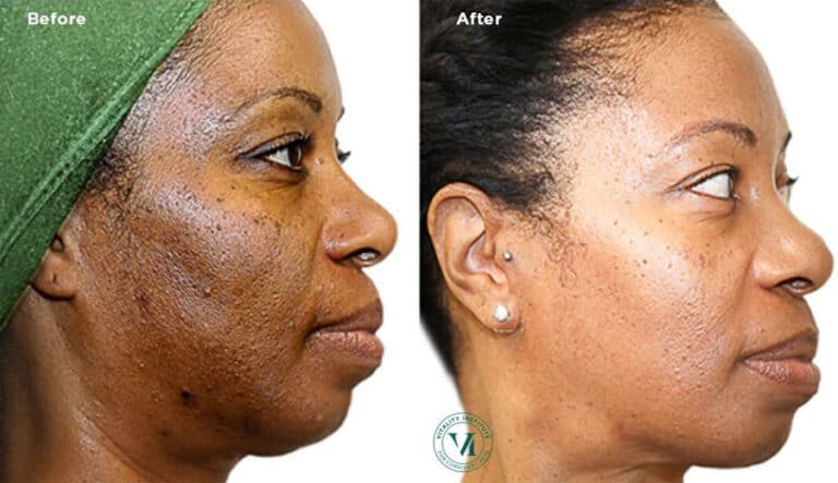 VI Peel Precision Plus before and after — hyperpigmentation and melasma improvement
