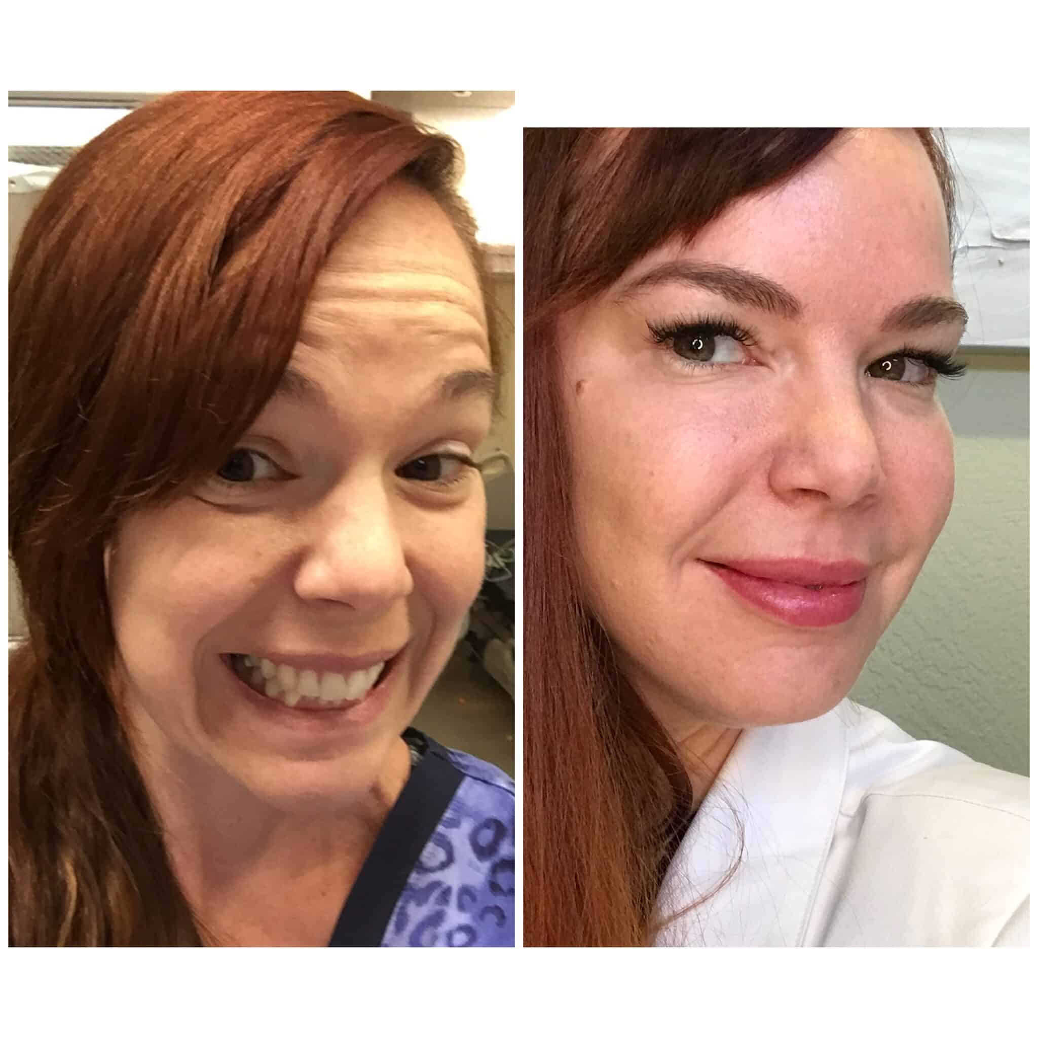Botox before and after — forehead and frown line smoothing