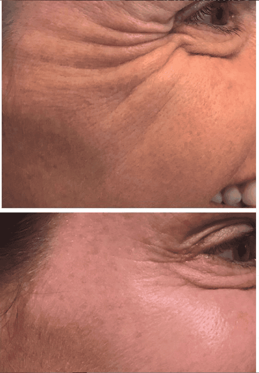 Botox before and after — crow's feet reduction
