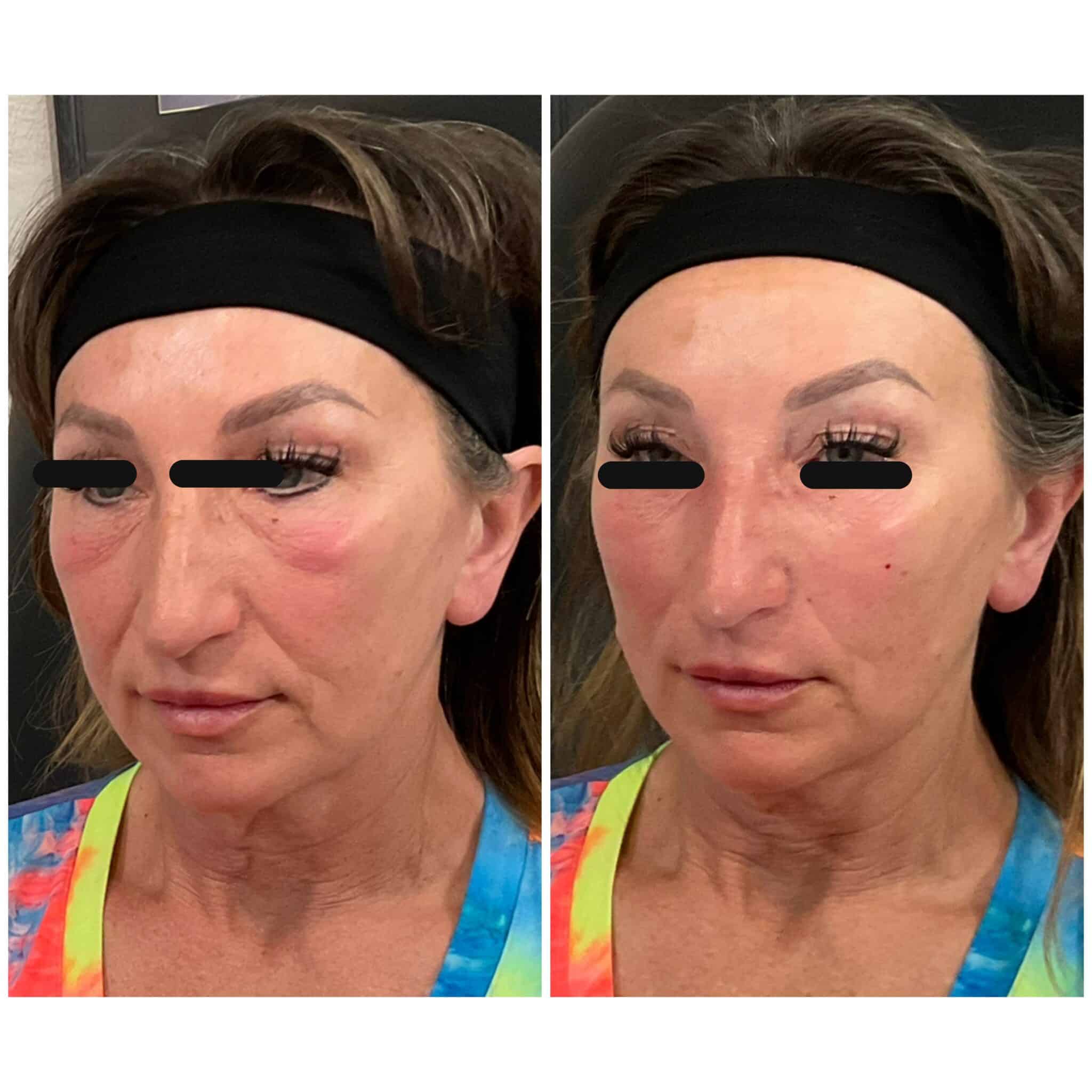 Dermal filler before and after — volume restoration and contouring