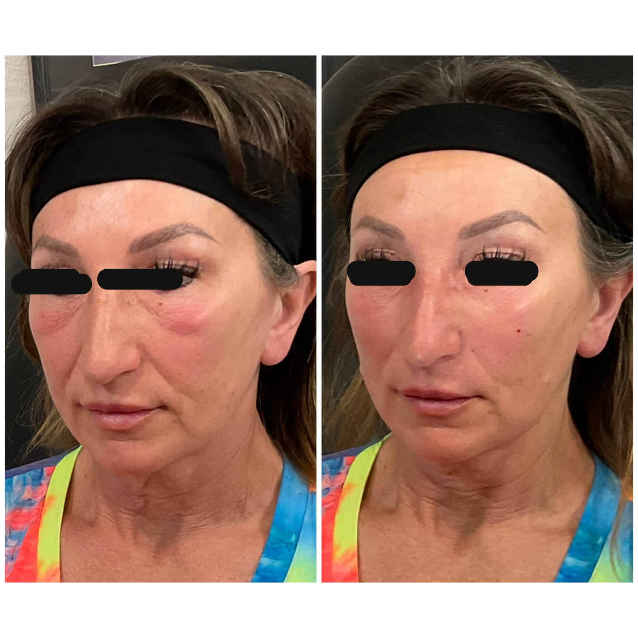 Dermal filler before and after — cheek volume restoration