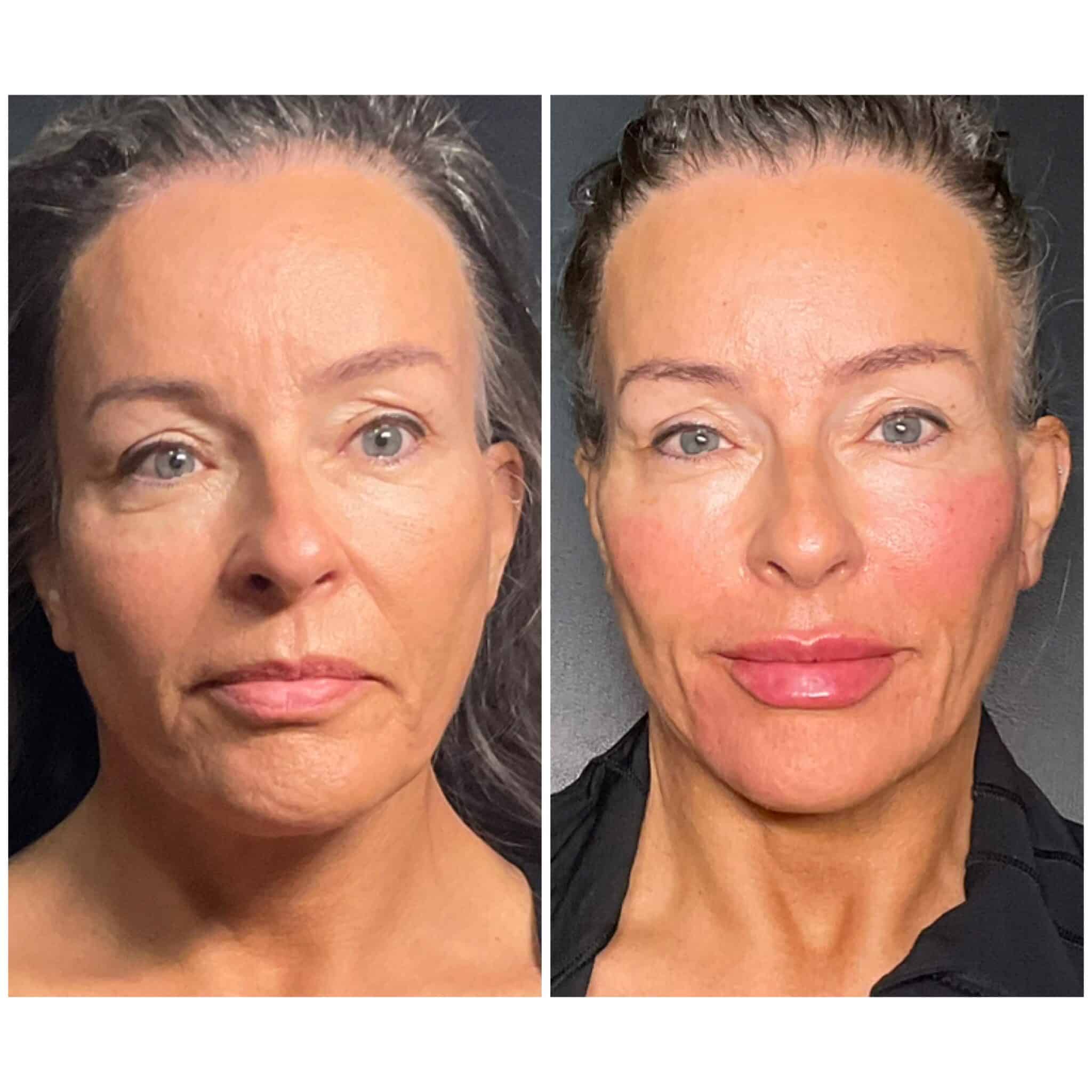 Dermal filler before and after — nasolabial fold and jawline