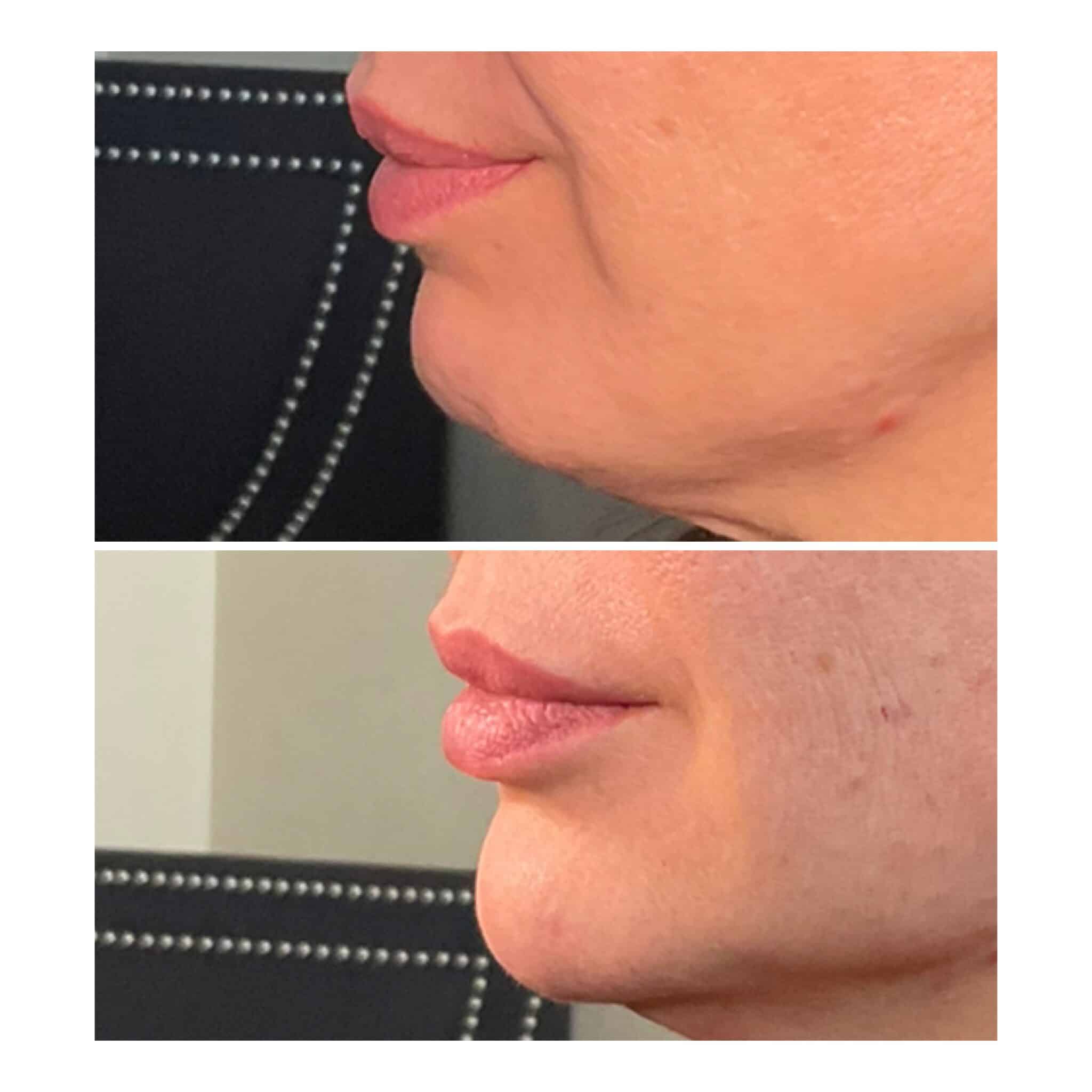 Facial balancing before and after — cheek and jawline definition