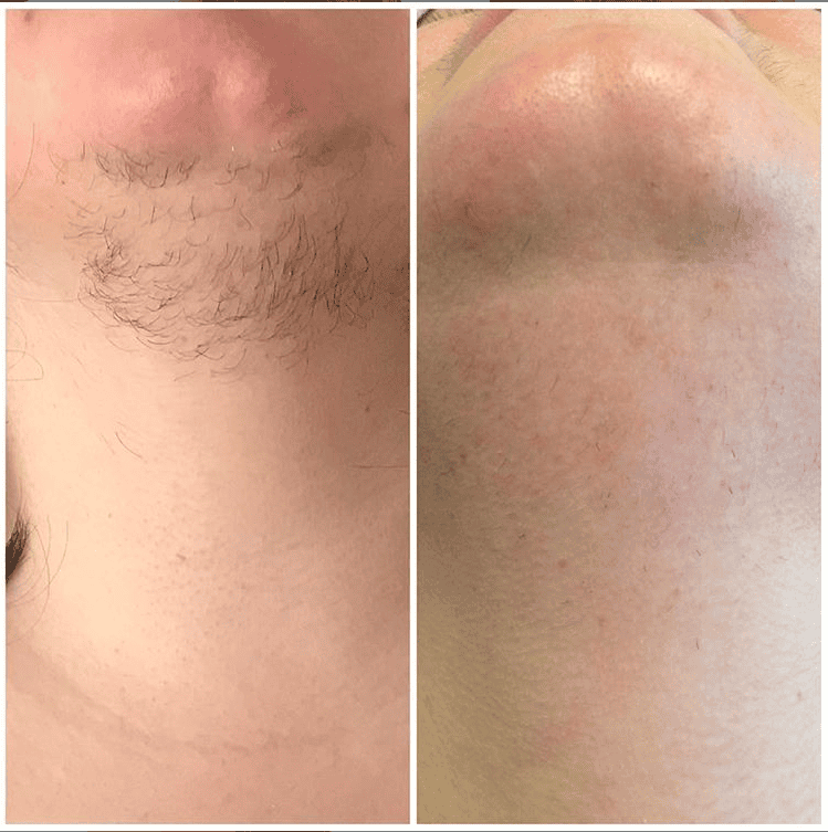 Laser hair removal before and after — permanent hair reduction