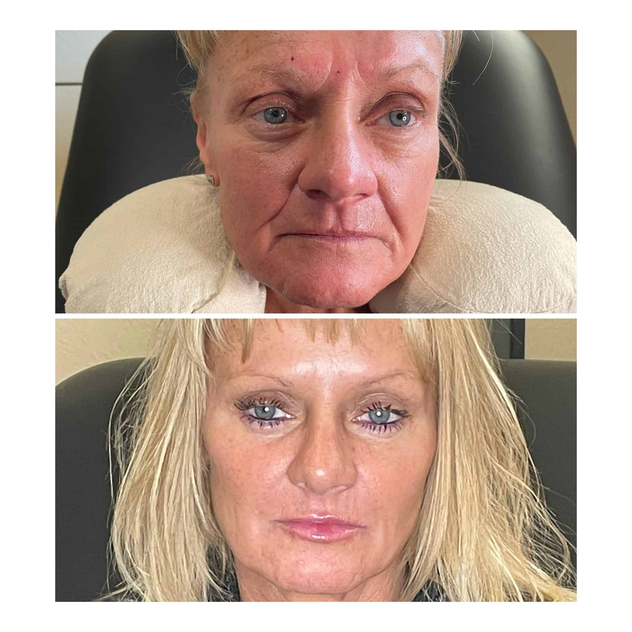 Lip filler before and after — volume and definition