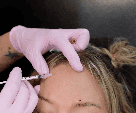 Botox treatment areas — provider administering injection