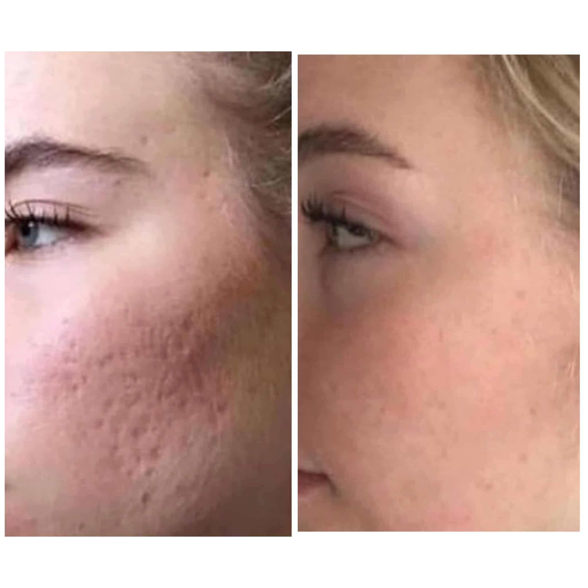 CO2 laser resurfacing before and after — acne scar reduction