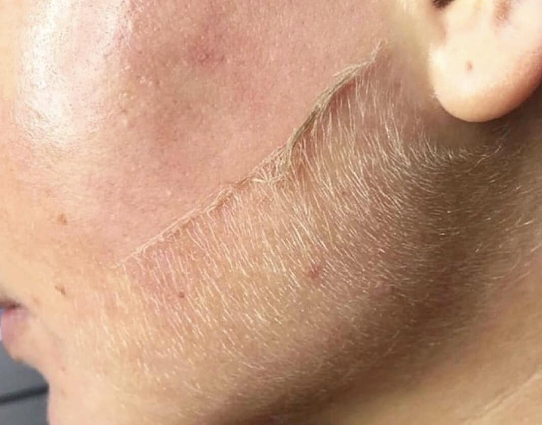 Dermaplaning treatment in progress at Illume Aesthetics — half-done showing contrast between treated smooth skin and untreated side