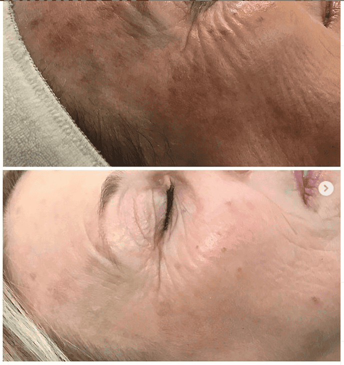 IPL photofacial before and after — sun damage and brown spot clearance