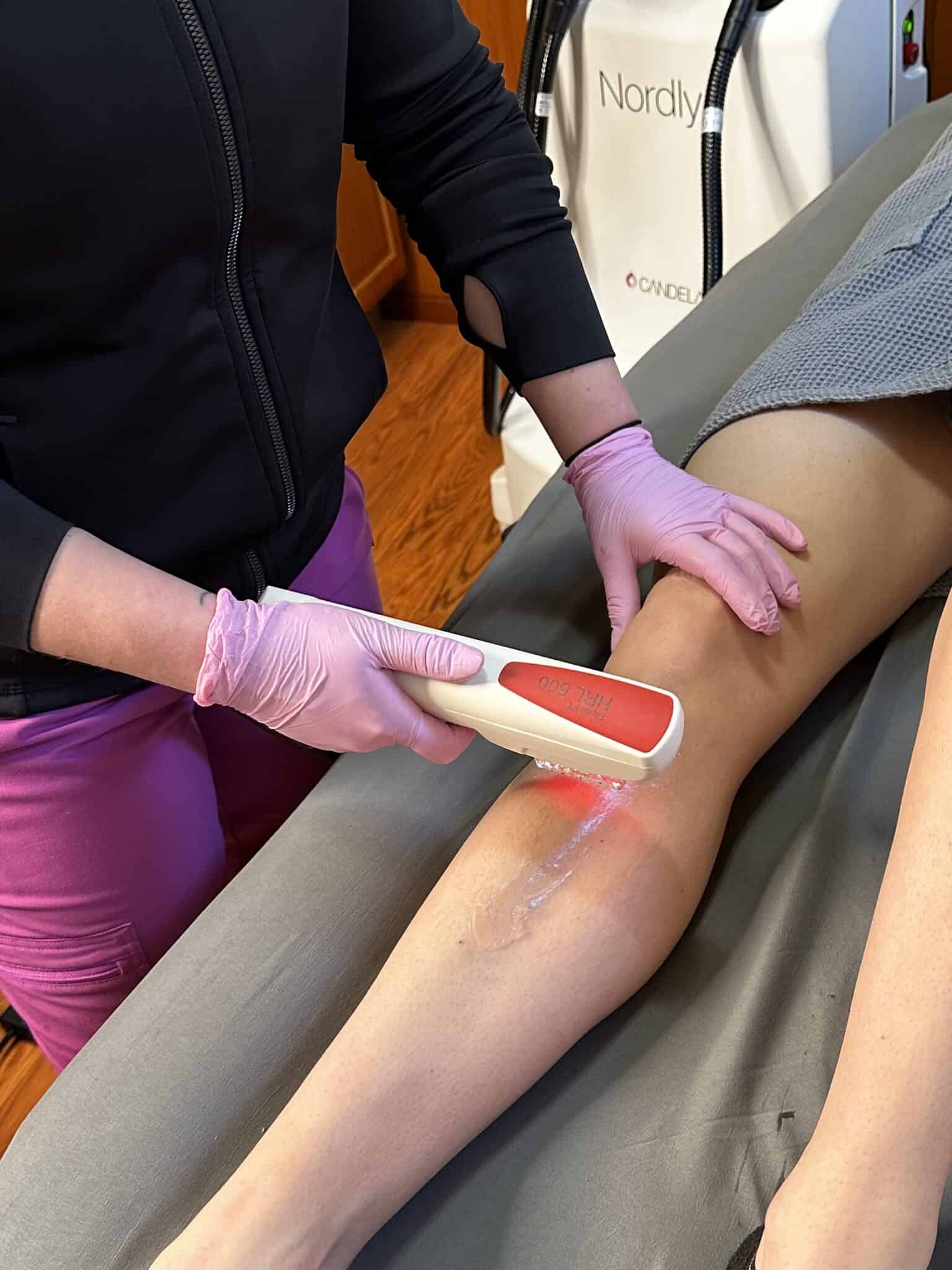 Laser hair removal treatment with Candela Nordlys