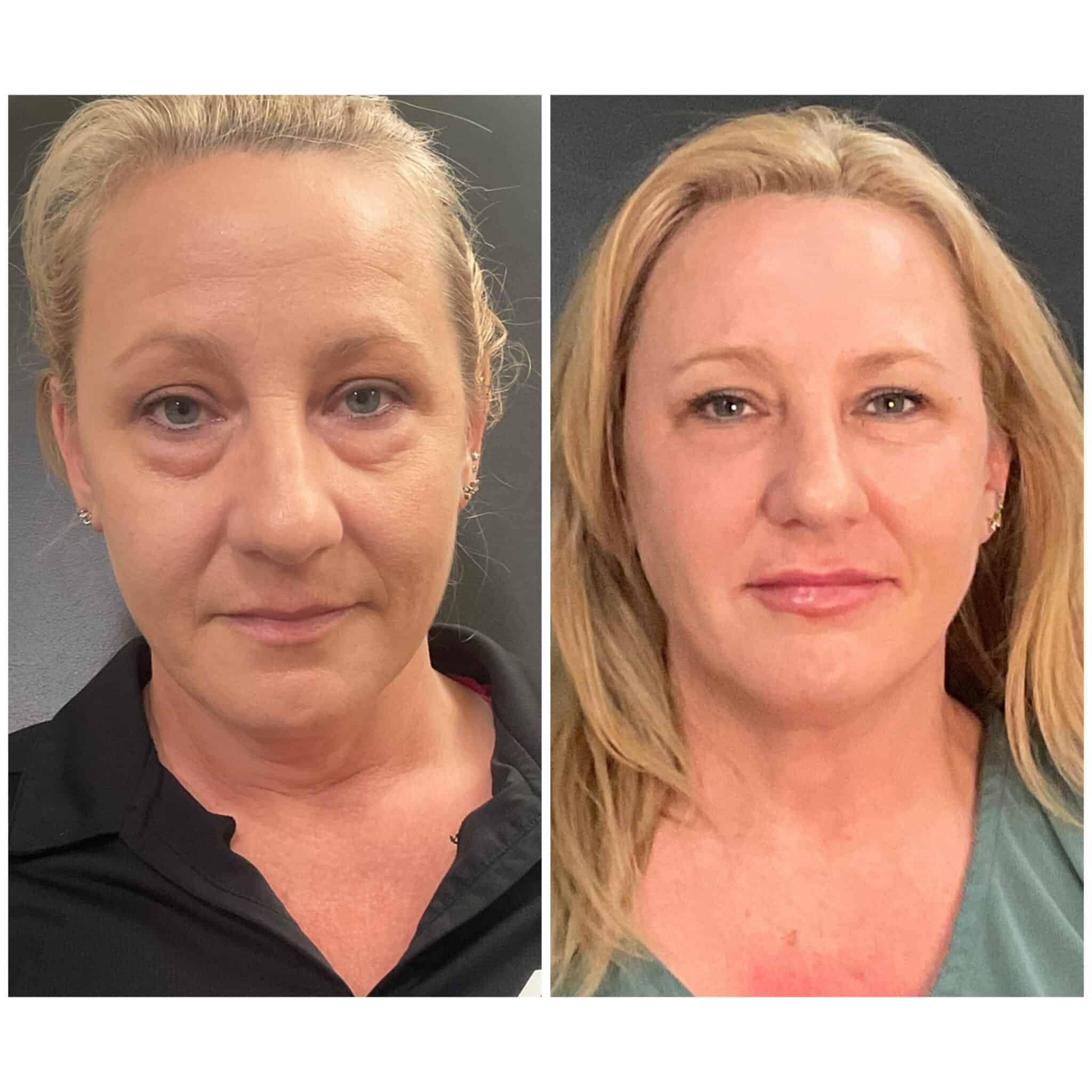 Liquid facelift before and after — full-face injectable rejuvenation