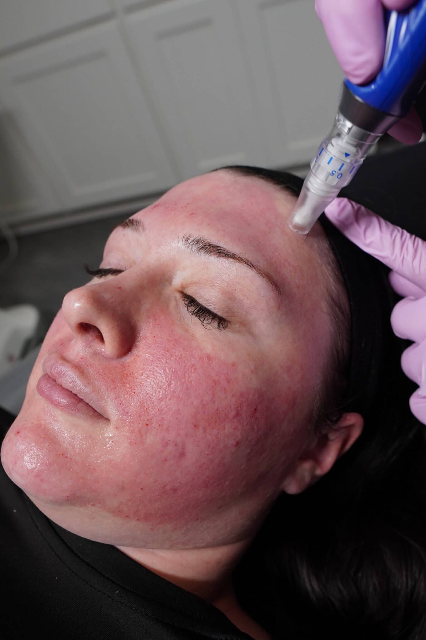 Close-up of SkinPen microneedling being performed on patient's face showing controlled micro-injury treatment pattern