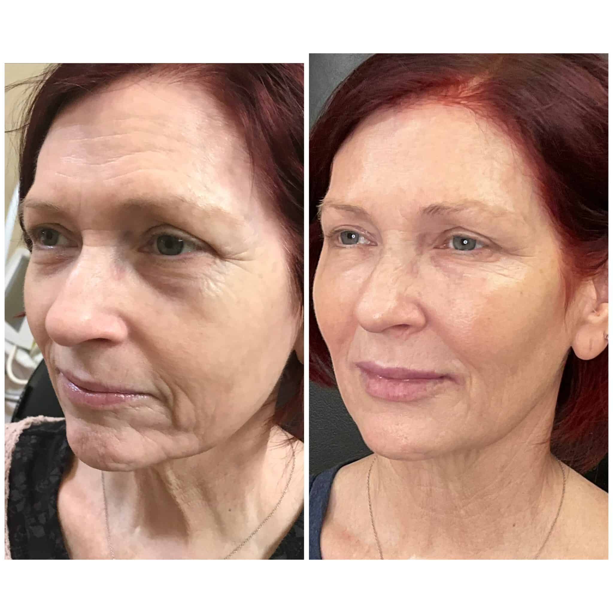 Non-surgical facelift before and after — Profound RF + laser + facial balancing