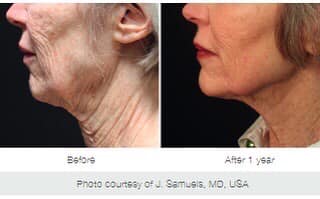 Profound RF before and after results — skin tightening, jawline definition, and wrinkle reduction