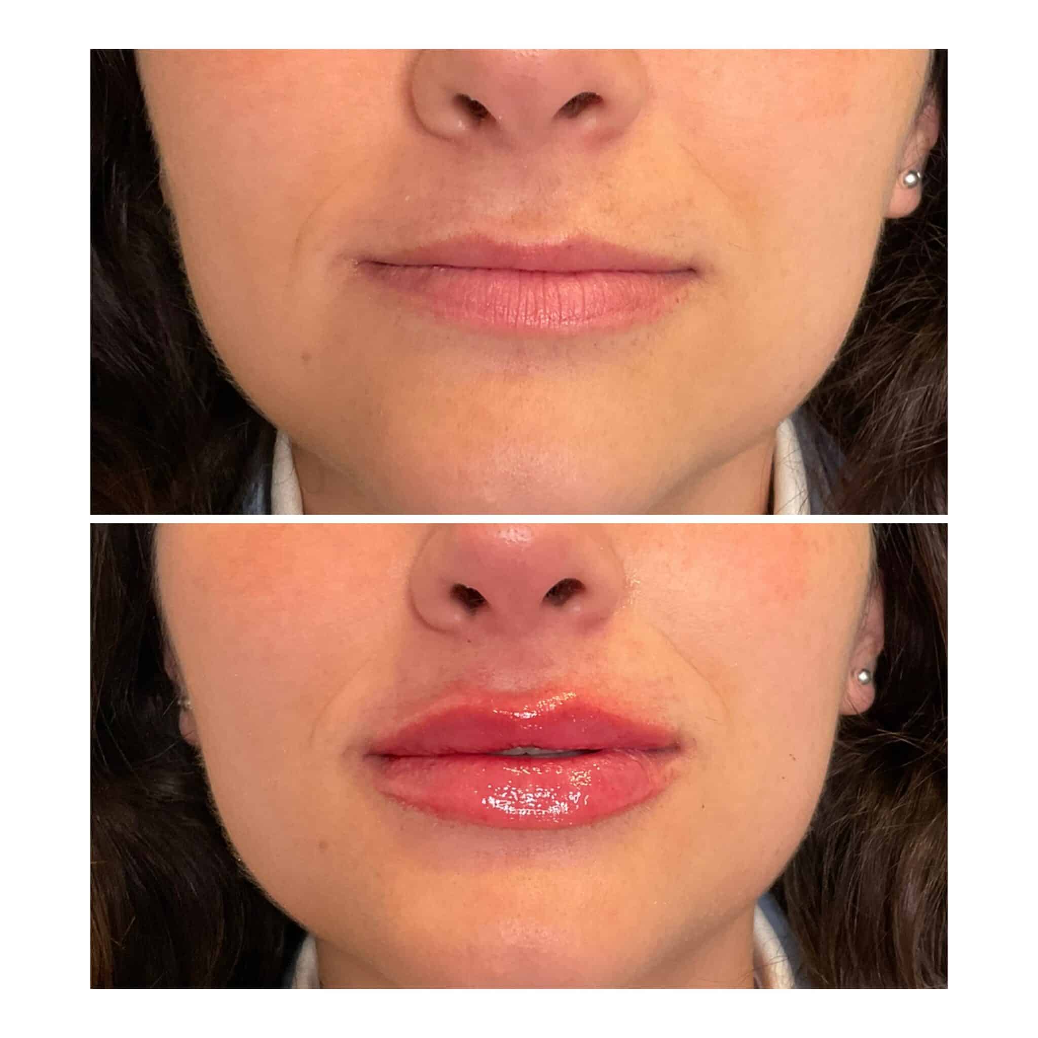 Lip filler before and after with natural enhancement by Illume Aesthetics