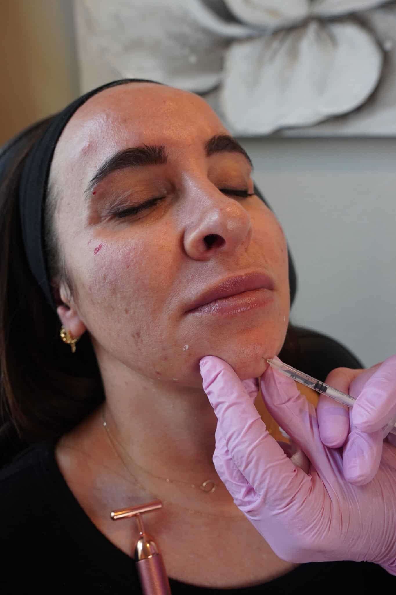 Treatment — filler injection for facial balancing