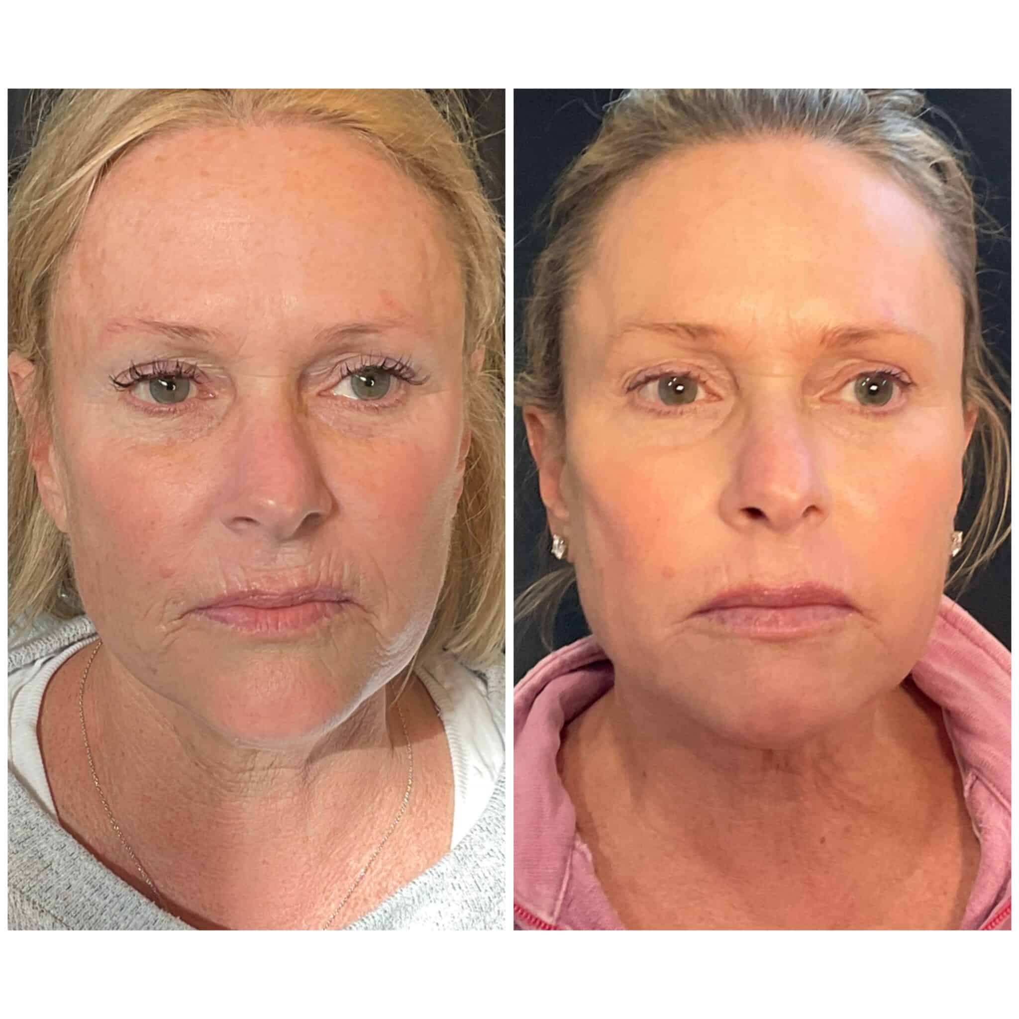 UltraClear laser before and after results — skin texture, tone, and clarity improvement